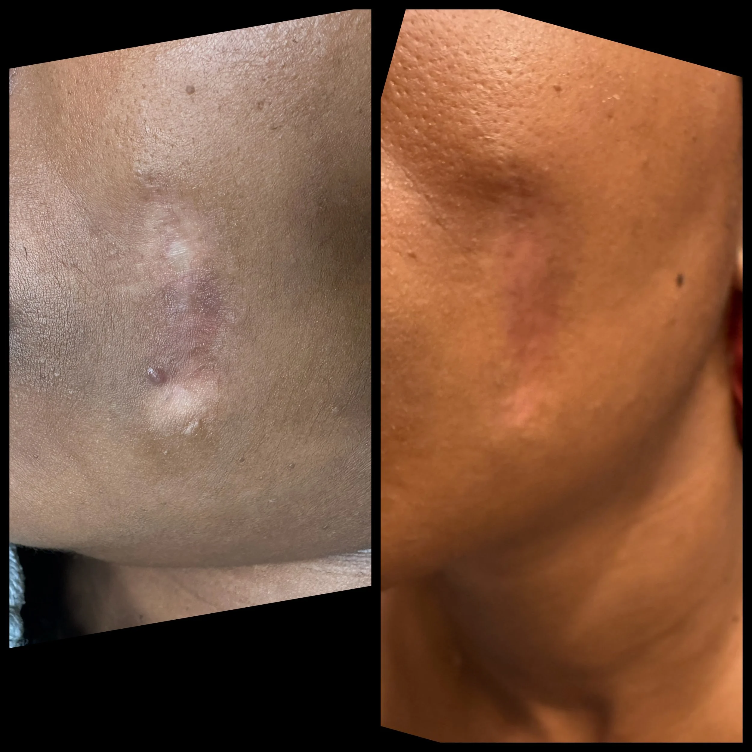 Restoring Confidence Through Medical Tattooing