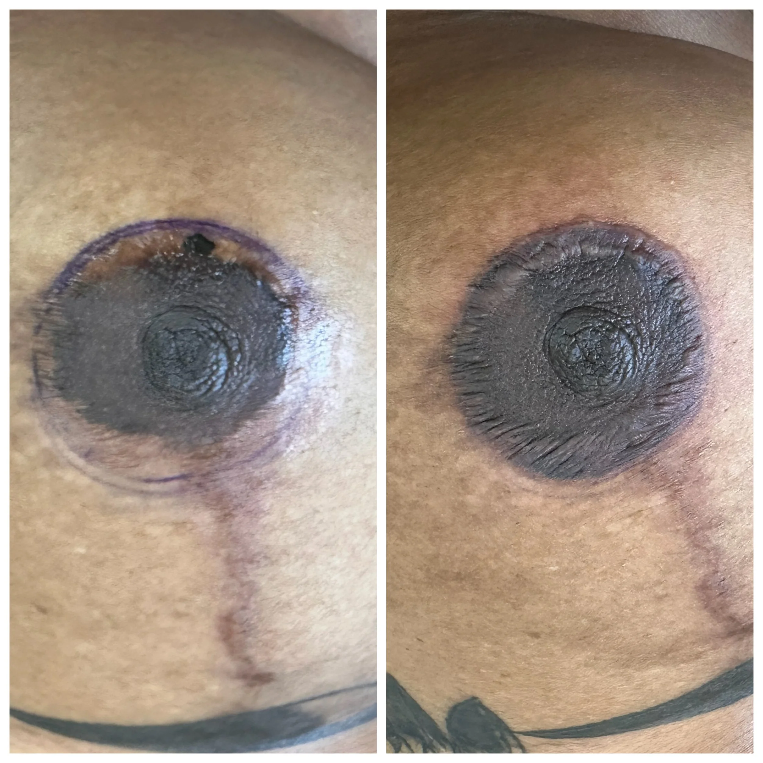 scarring post breast lift