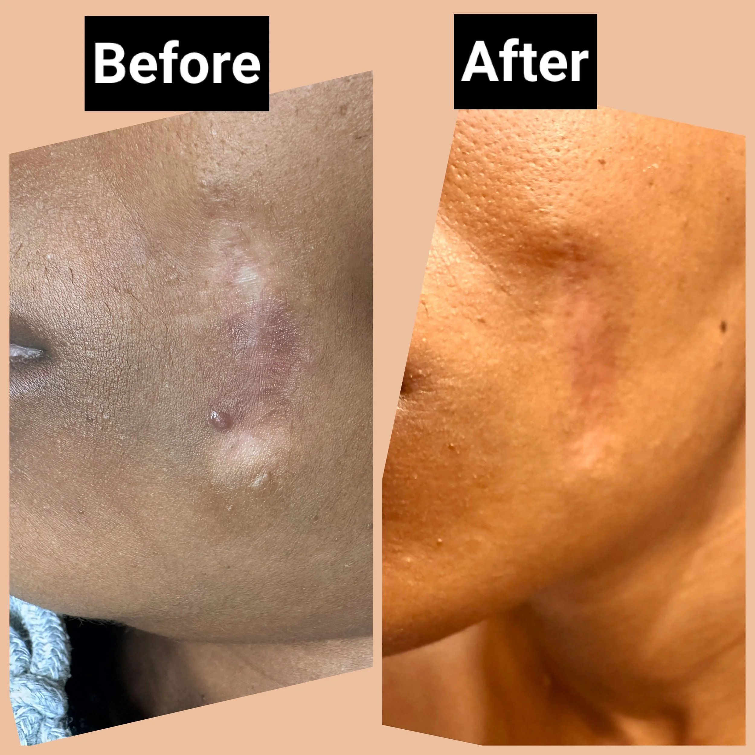 scar face cover tattoo ink blend away