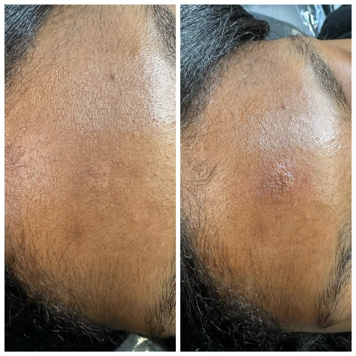 smp-scalp-micropigmentation-before-after-maryland-glow-studio.jpg