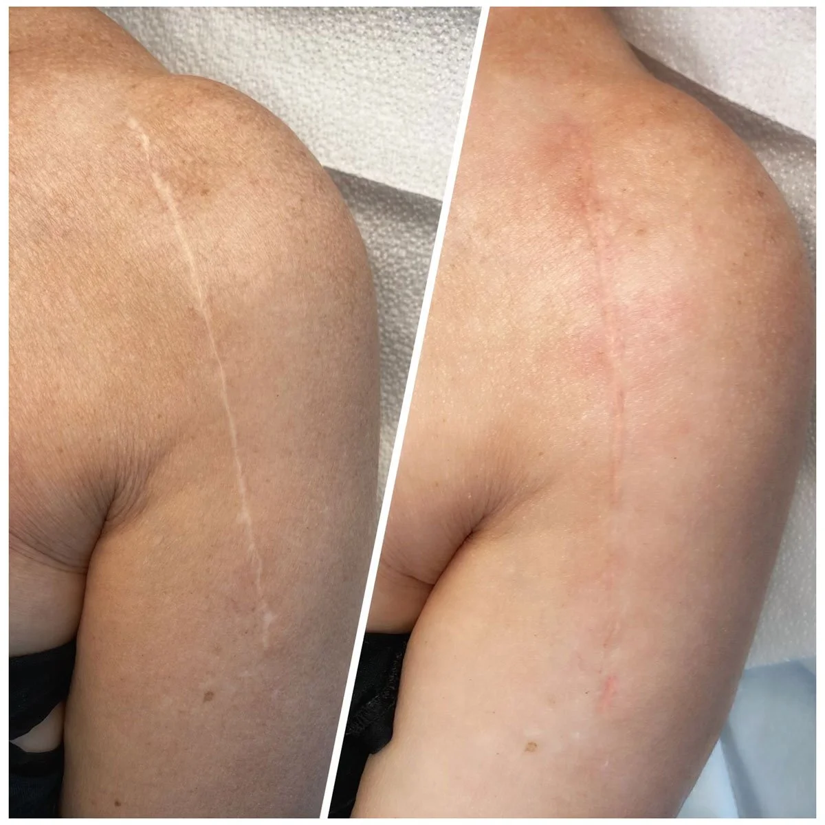stretch-mark-removal-camouflage-tattoo-permanent-solution-glow.jpg