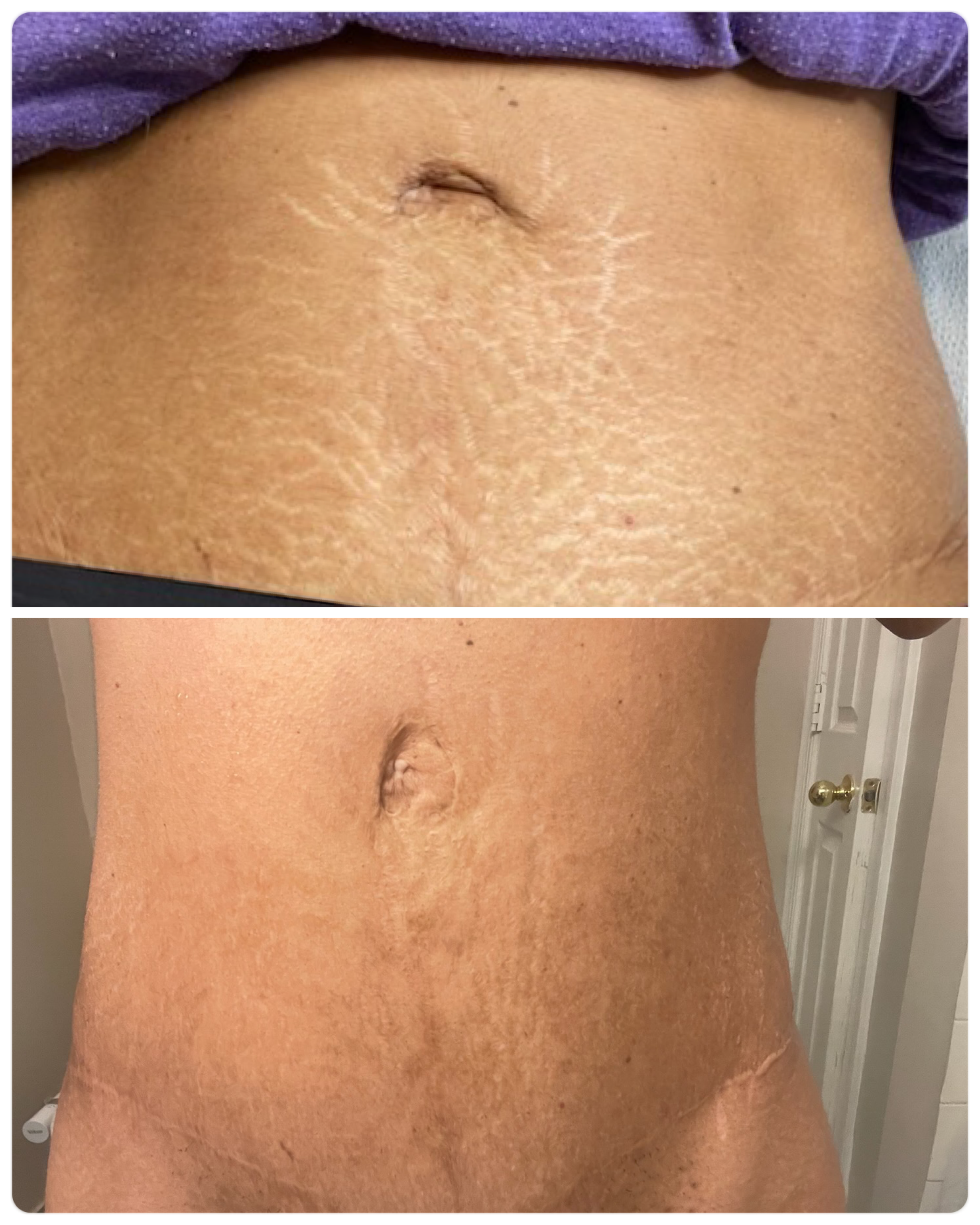 before after stretch mark camouflage