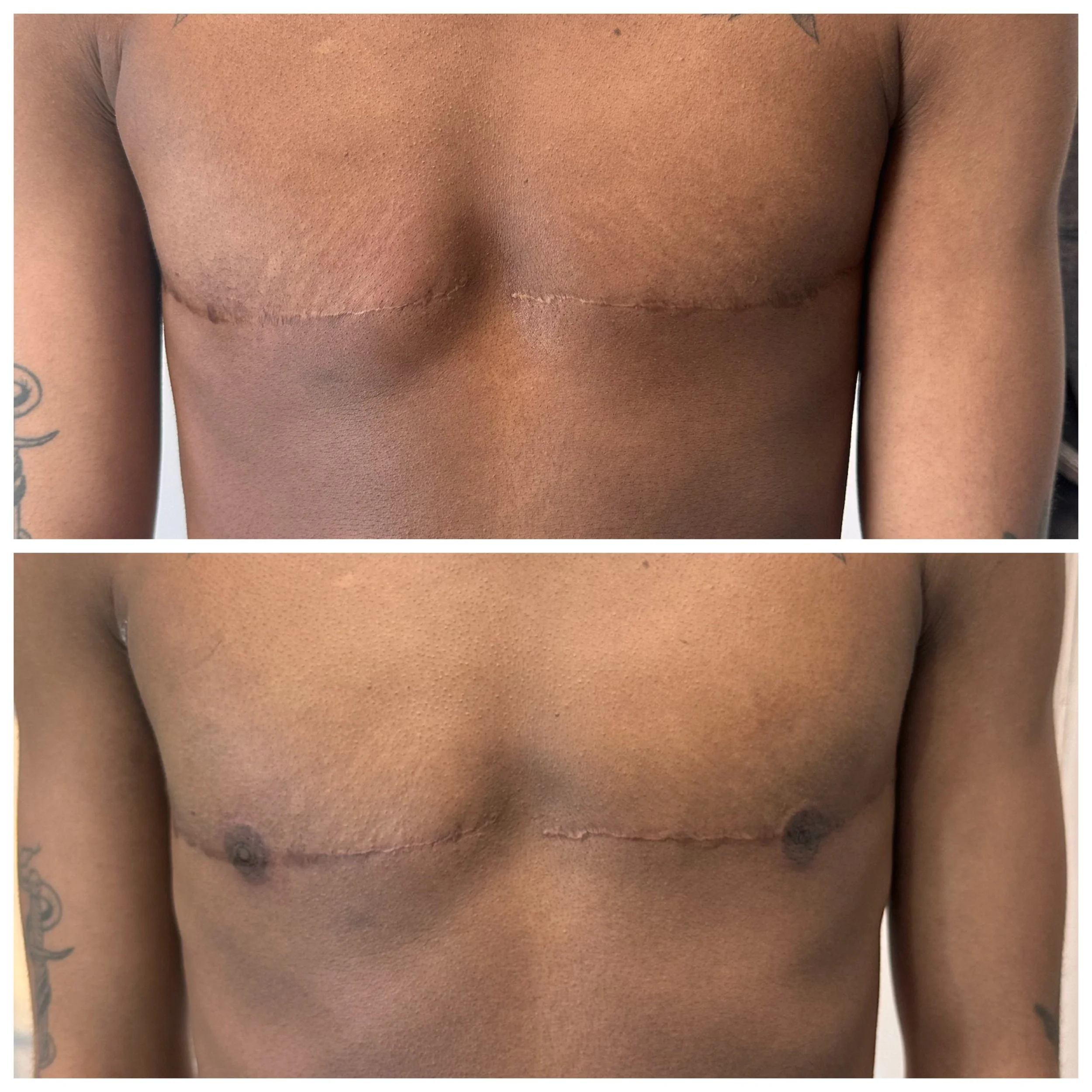 areola tattoo post surgery