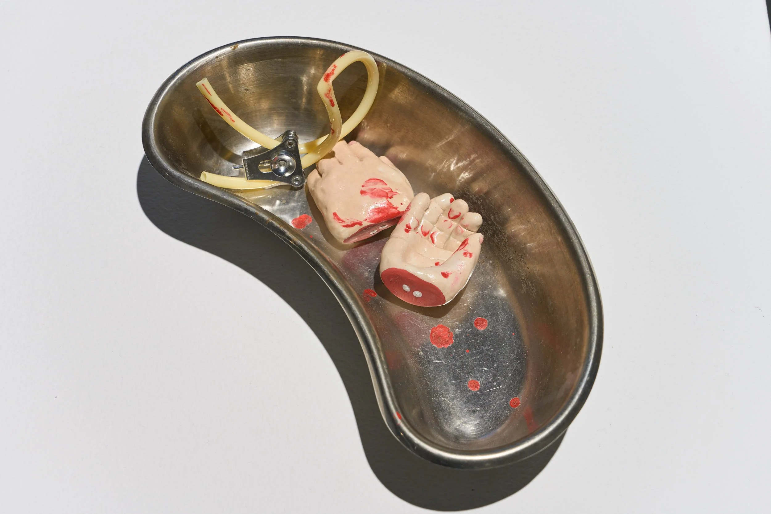 A surgical stainless steel kidney dish holding two sculpted, severed infant hands with droplets of blood. There is an object with a yellow tube and a metal fastener in the dish also.