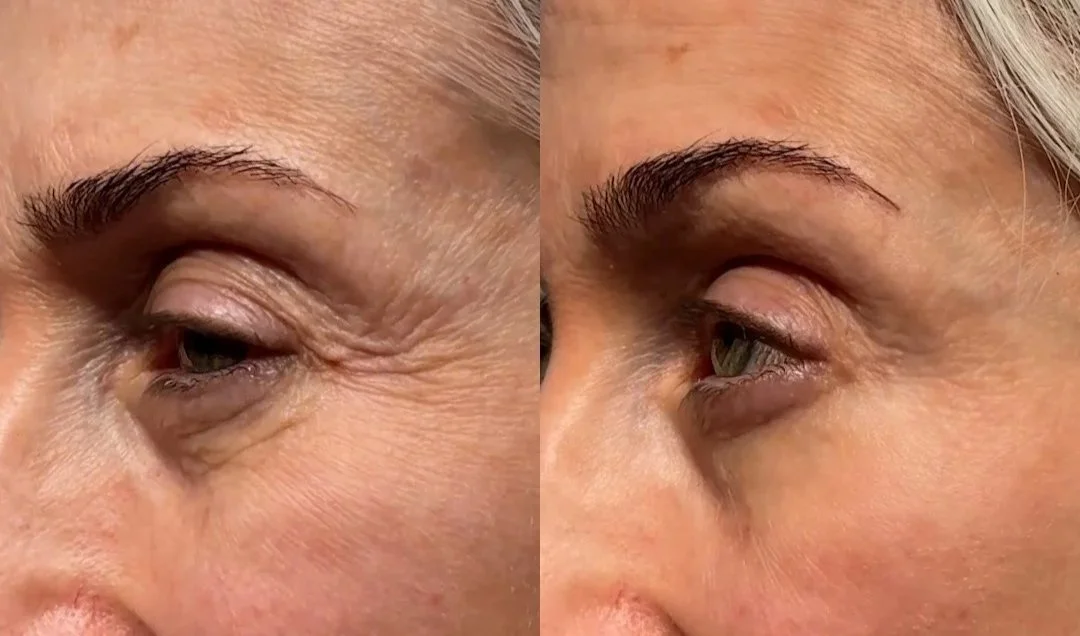 Facial wrinkle reduction – Providence, Rhode Island