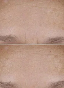 Non-invasive wrinkle reduction – Restorative Tattoo Specialist Michelle Lee