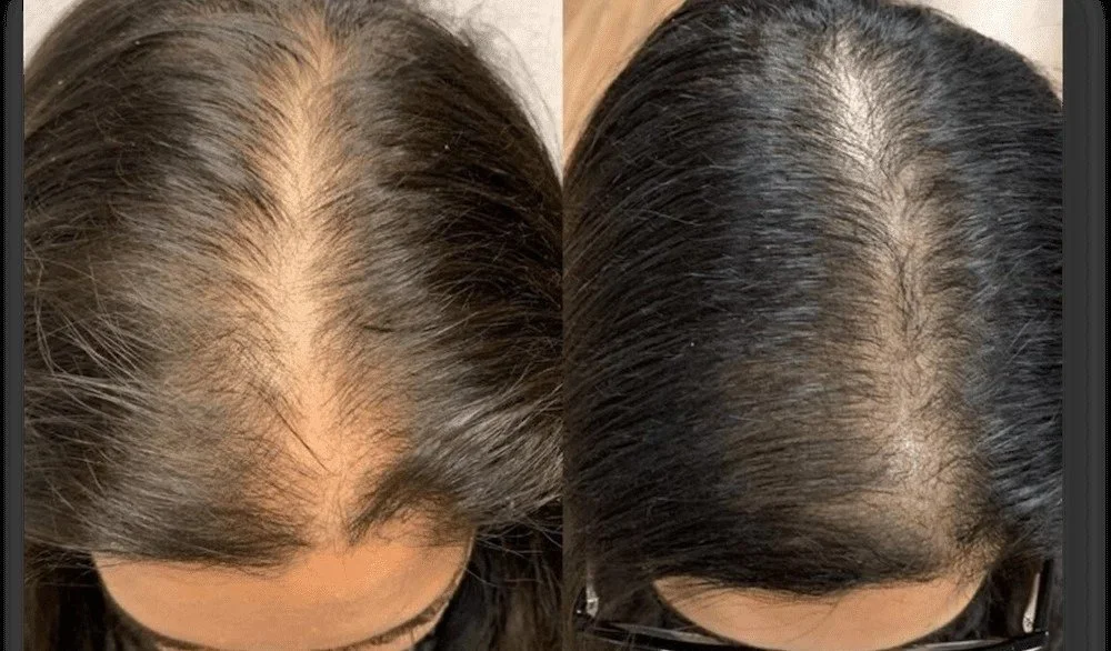 Hair regeneration treatment before and after – Providence RI