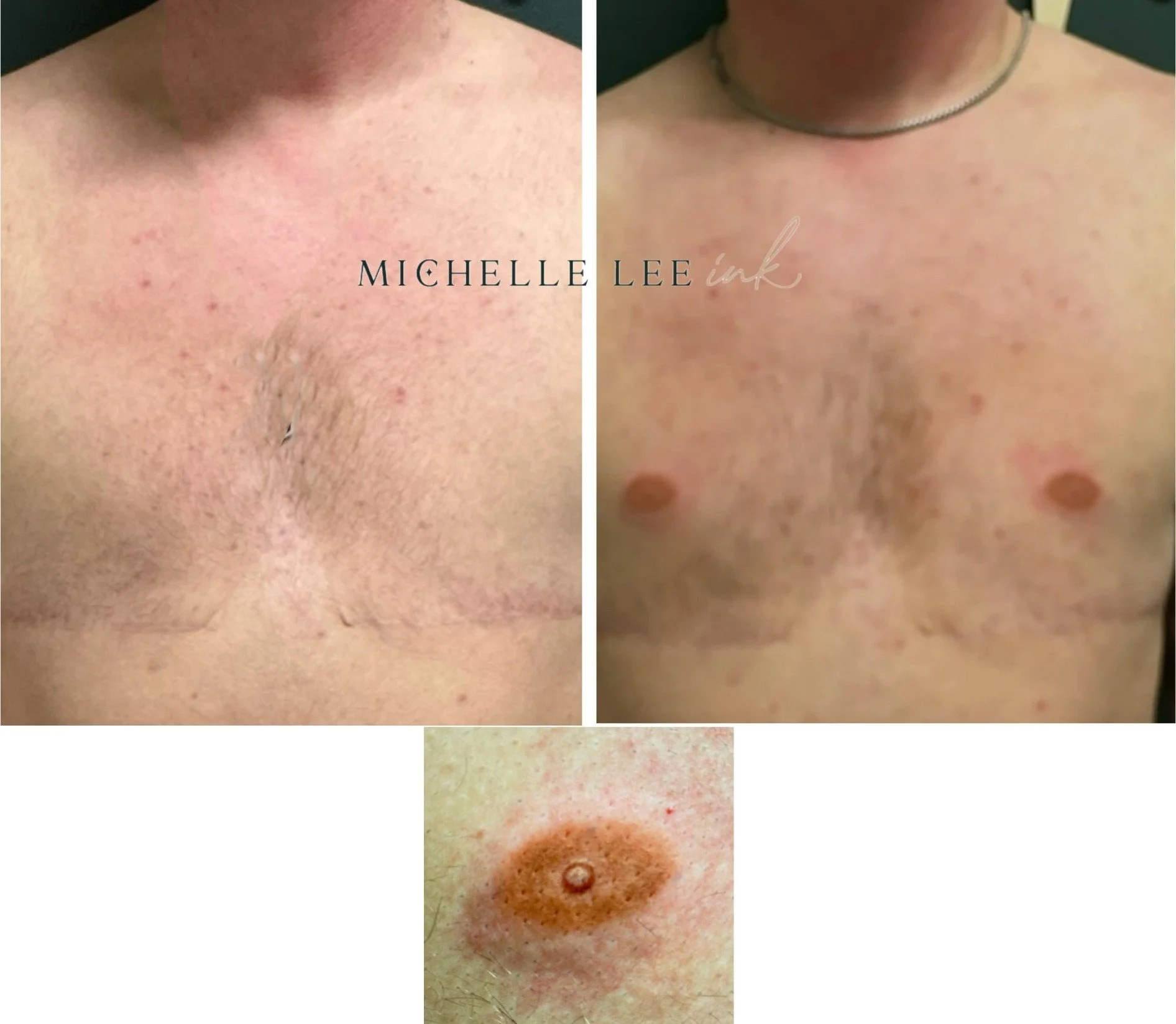 Benson Case-Transgender male top surgery.jpg