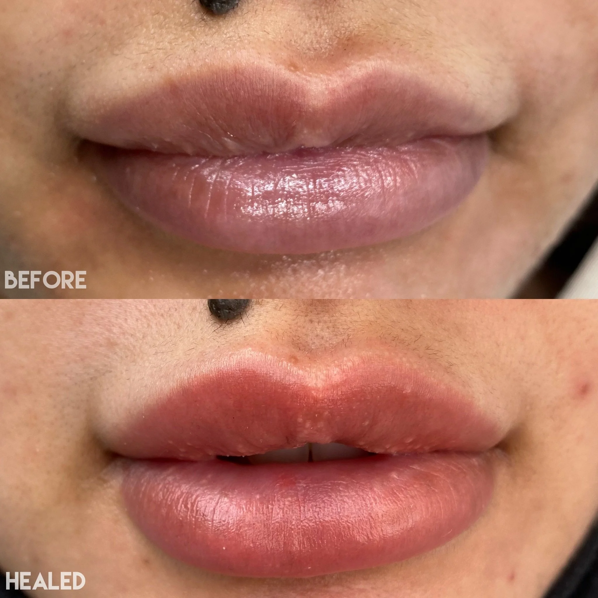 Dark Lip Neutralization