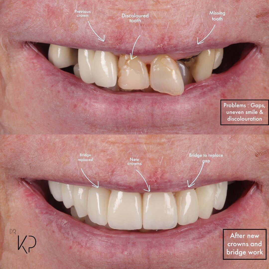 ☑️ REFRESHING an old worn smile | ultra conservative porcelain crowns and bridges 

🎯 Treatment goal 

This patient wanted a natural looking healthier smile 

🙏 Treatment by Dr Kal : 
we replaced the old bridges with a new porcelain bridge and plac