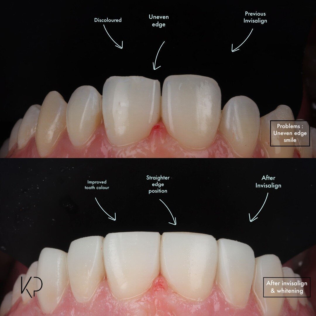 ☑️ COMPOSITE EDGE BONDING| Composite bonding

🎯 Treatment goal 

This patient wanted an even looking healthier smile following Invisalign 

🙏 Treatment by Dr Kal : 
We restored the uneven edges of the front six teeth following teeth alignment and w