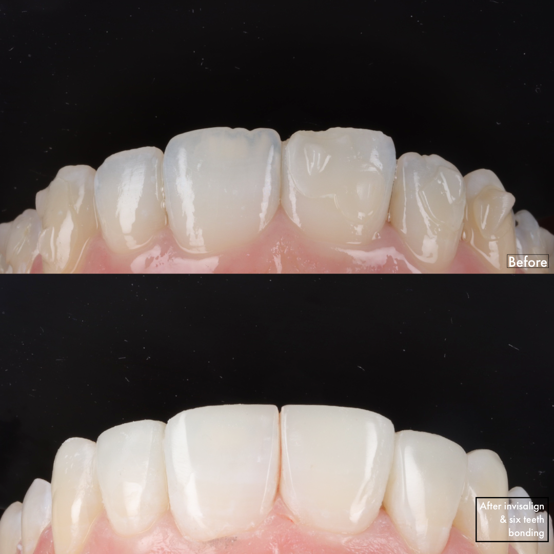 Invisalign Smile Makeover [ + 6 Teeth Bonding] — Dr Kal | Cosmetic Dentist