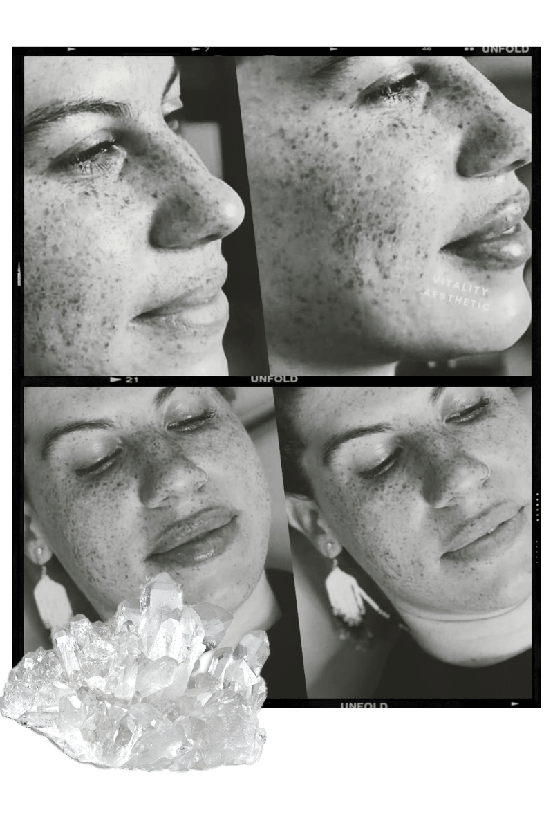 Before and after photos of Mia with lip filler