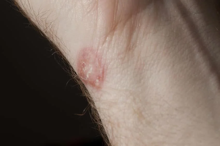 Ringer­flechte im Grappling: Ursachen, Risiko &amp; Prävention(auch bekannt als Ringworm, Tinea, Dermatophytose)