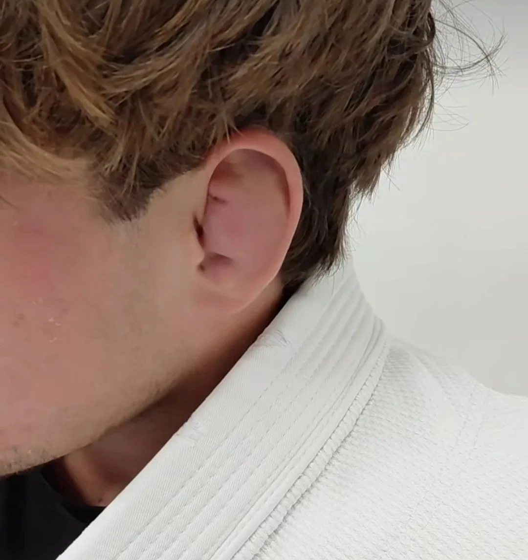 🥦 Cauliflower Ear im Jiu-Jitsu – Was es ist, wie es entsteht und was du wirklich tun solltest