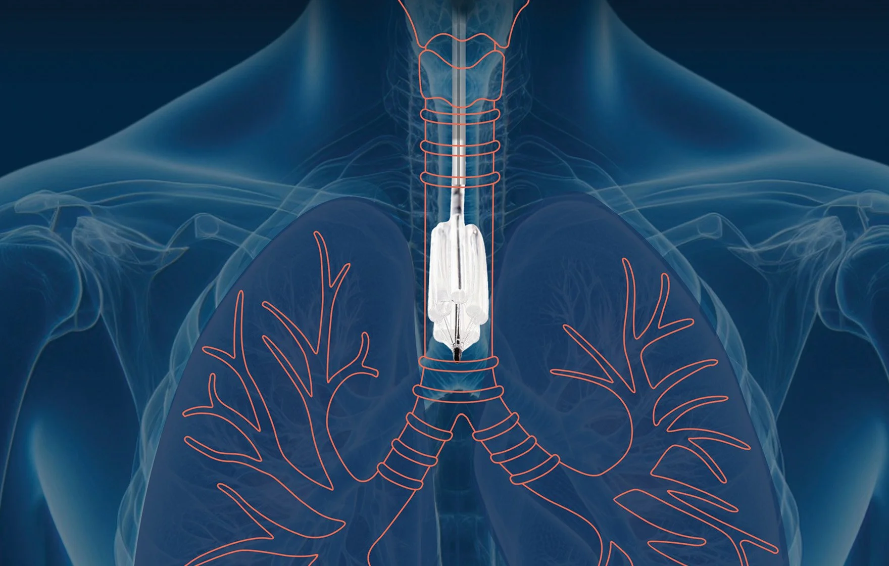 DISA Medinotec, Trachealator