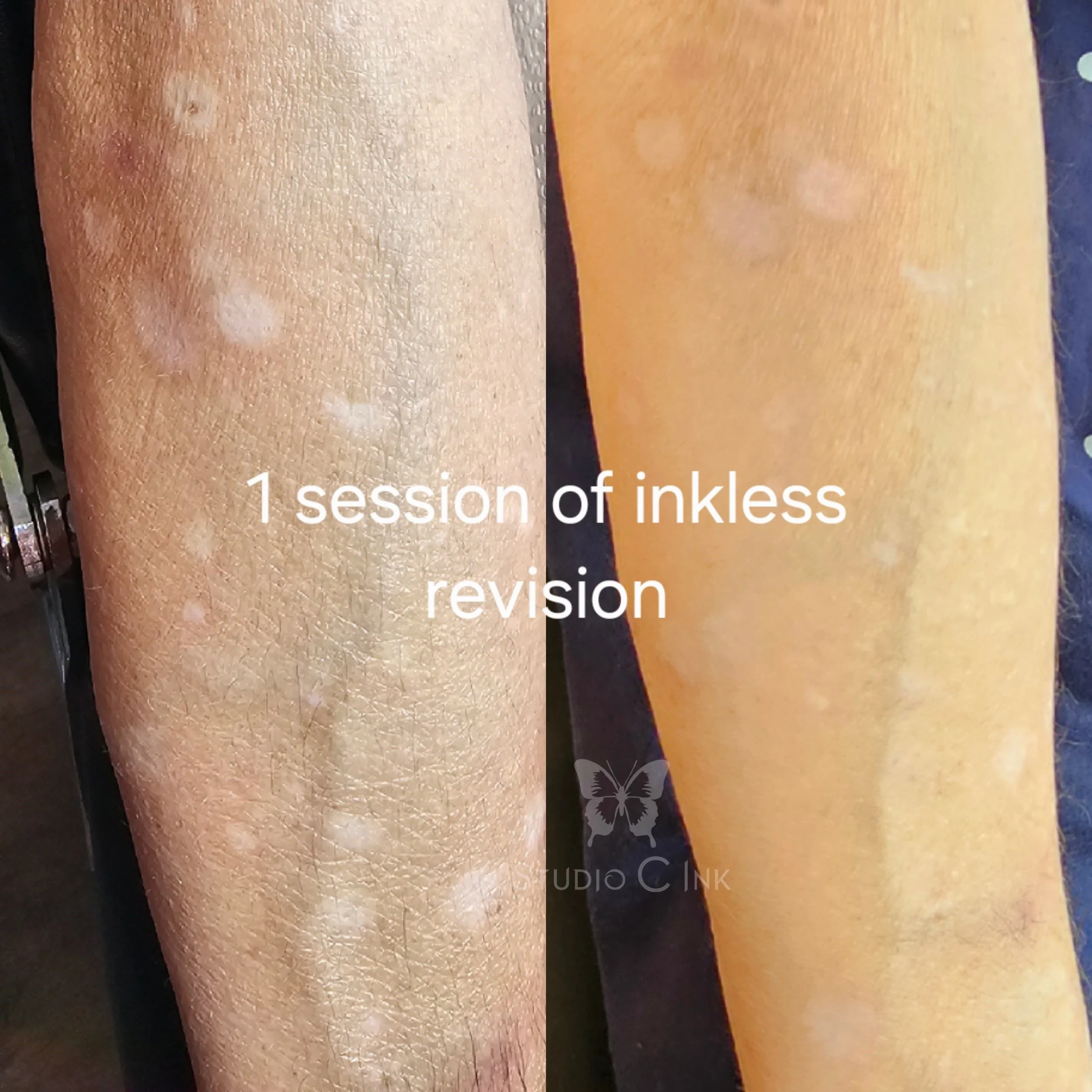 Scar Camouflage Inkless Scar Revision