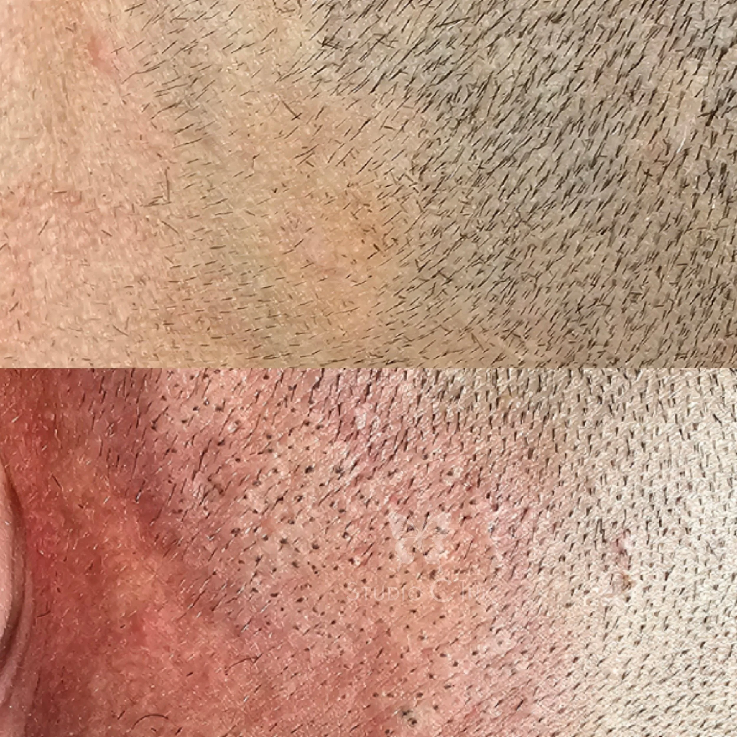 Scalp micropigmentation scar camouflage
