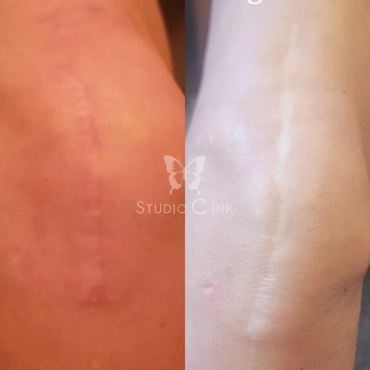 Paramedical Tattoo Near Me Experts for Medical Procedures