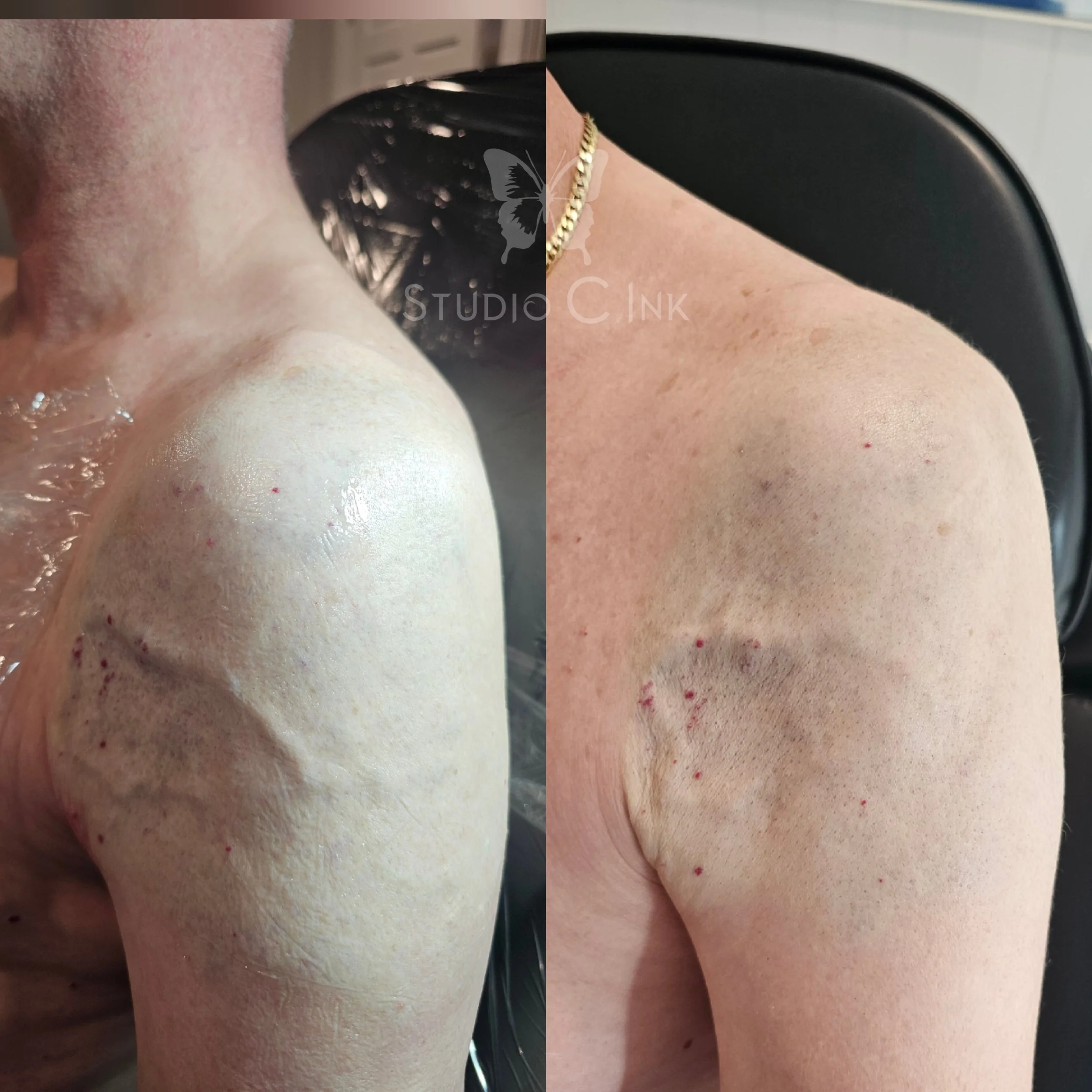 Scar Camouflage of a large birth mark