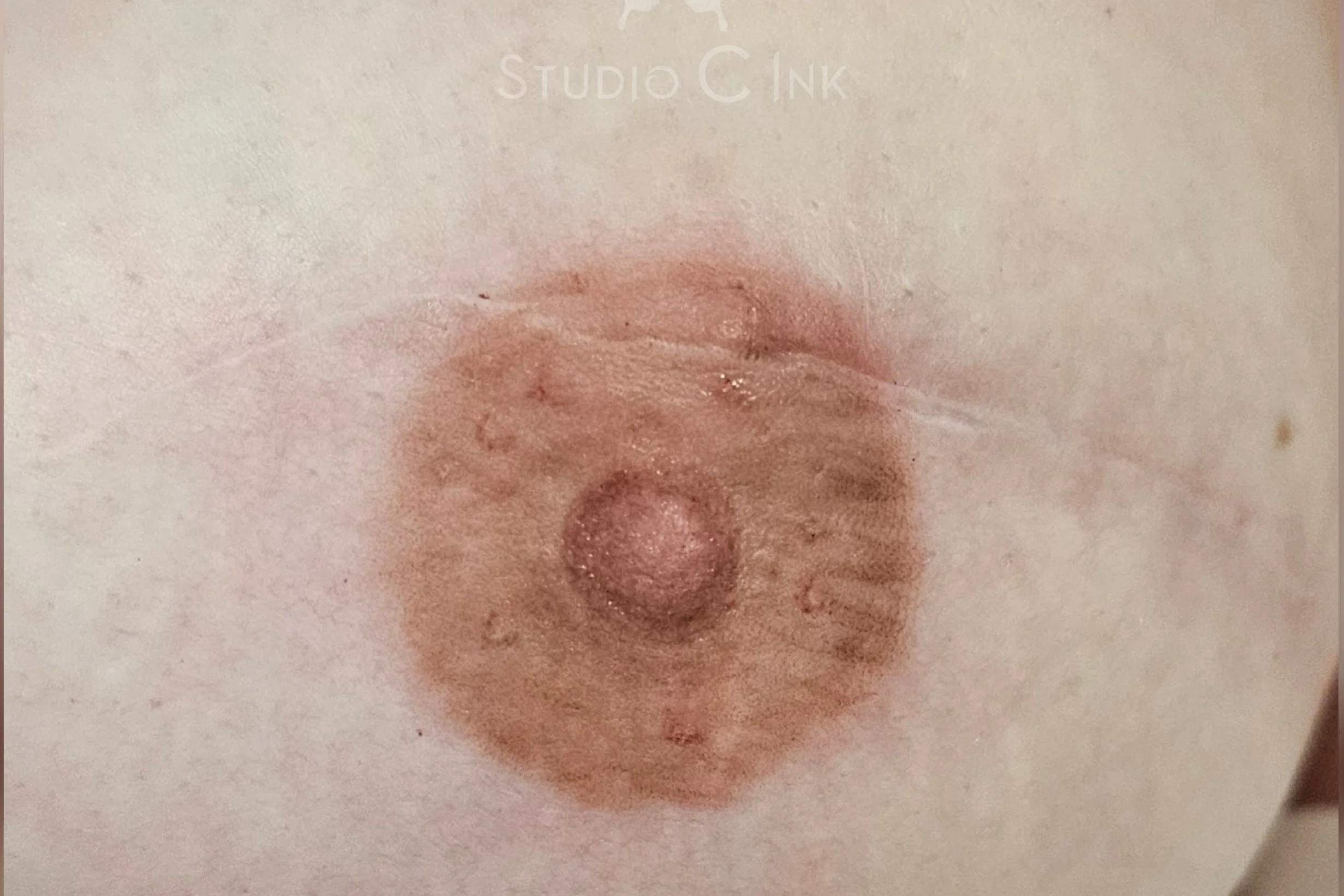 areola restoration