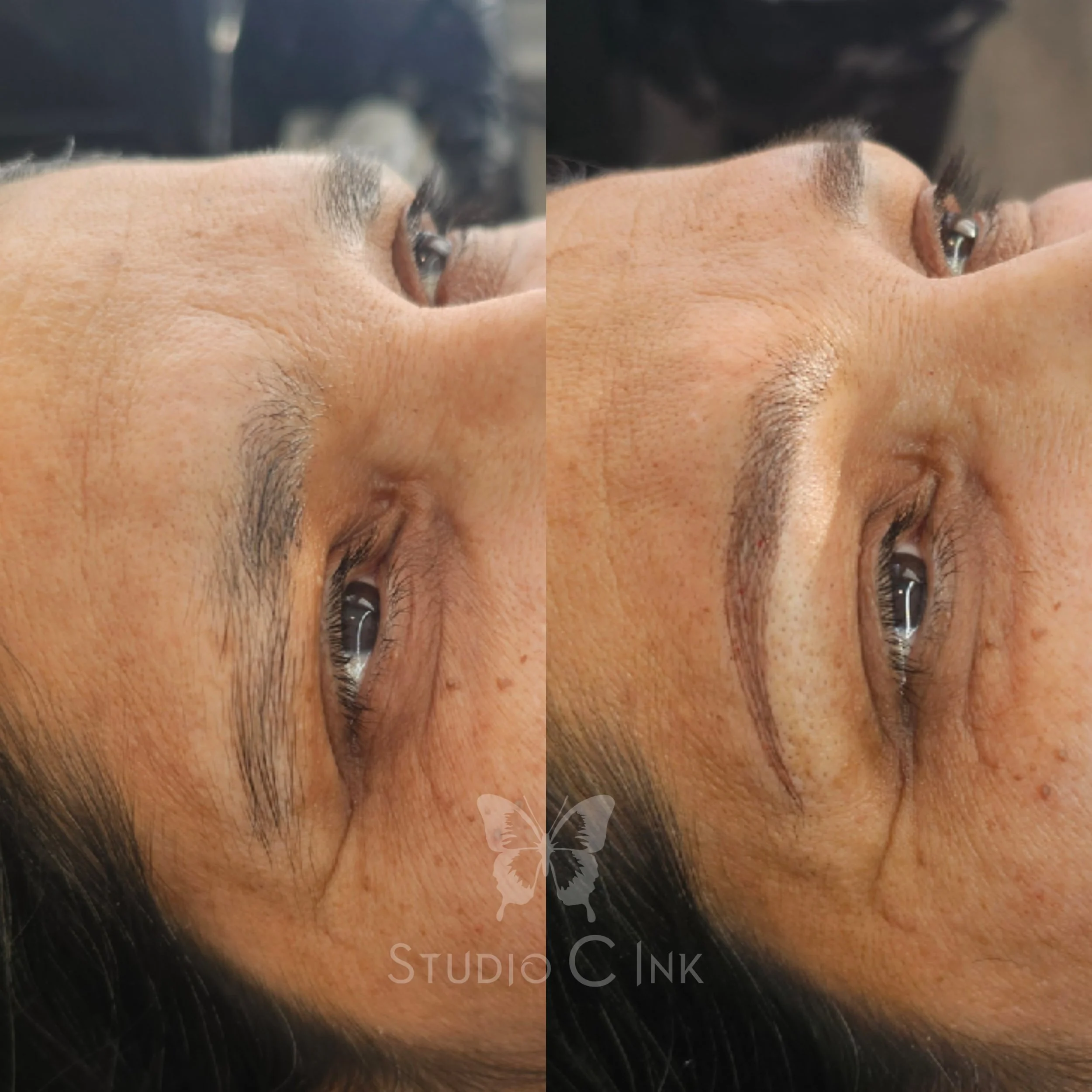 Brow correction