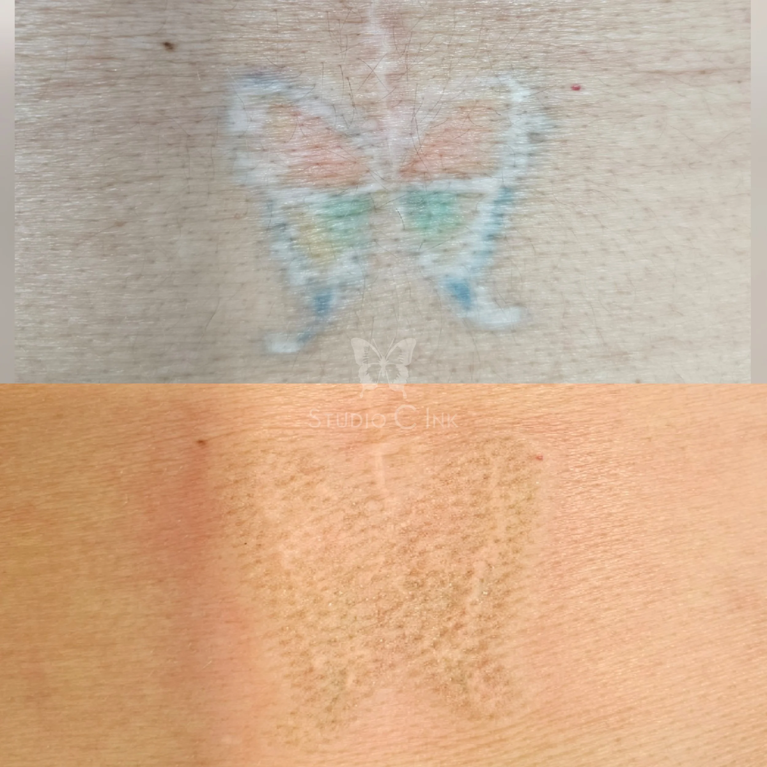 Tattoo cover up after several laser removal sessions