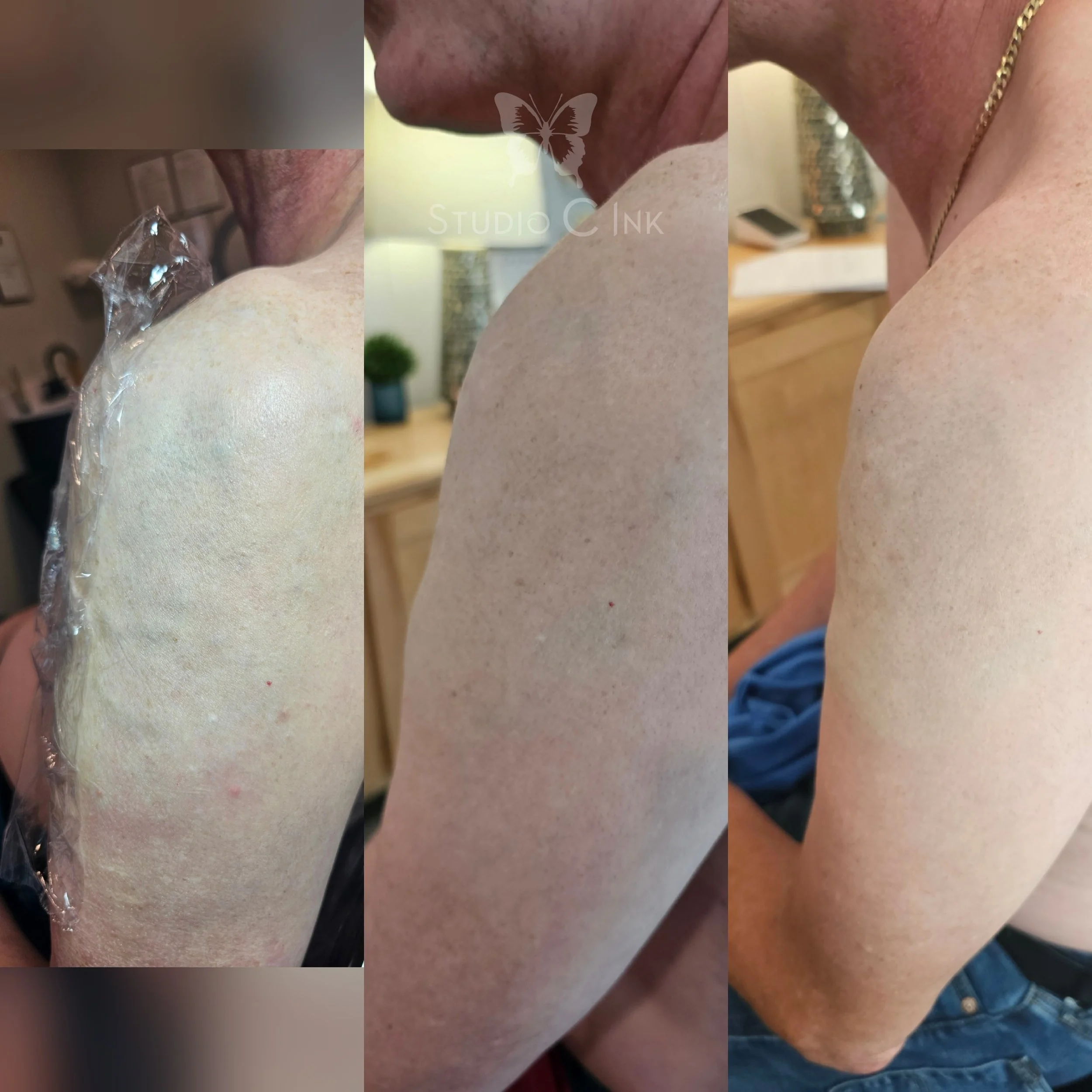 Skin repigmentation