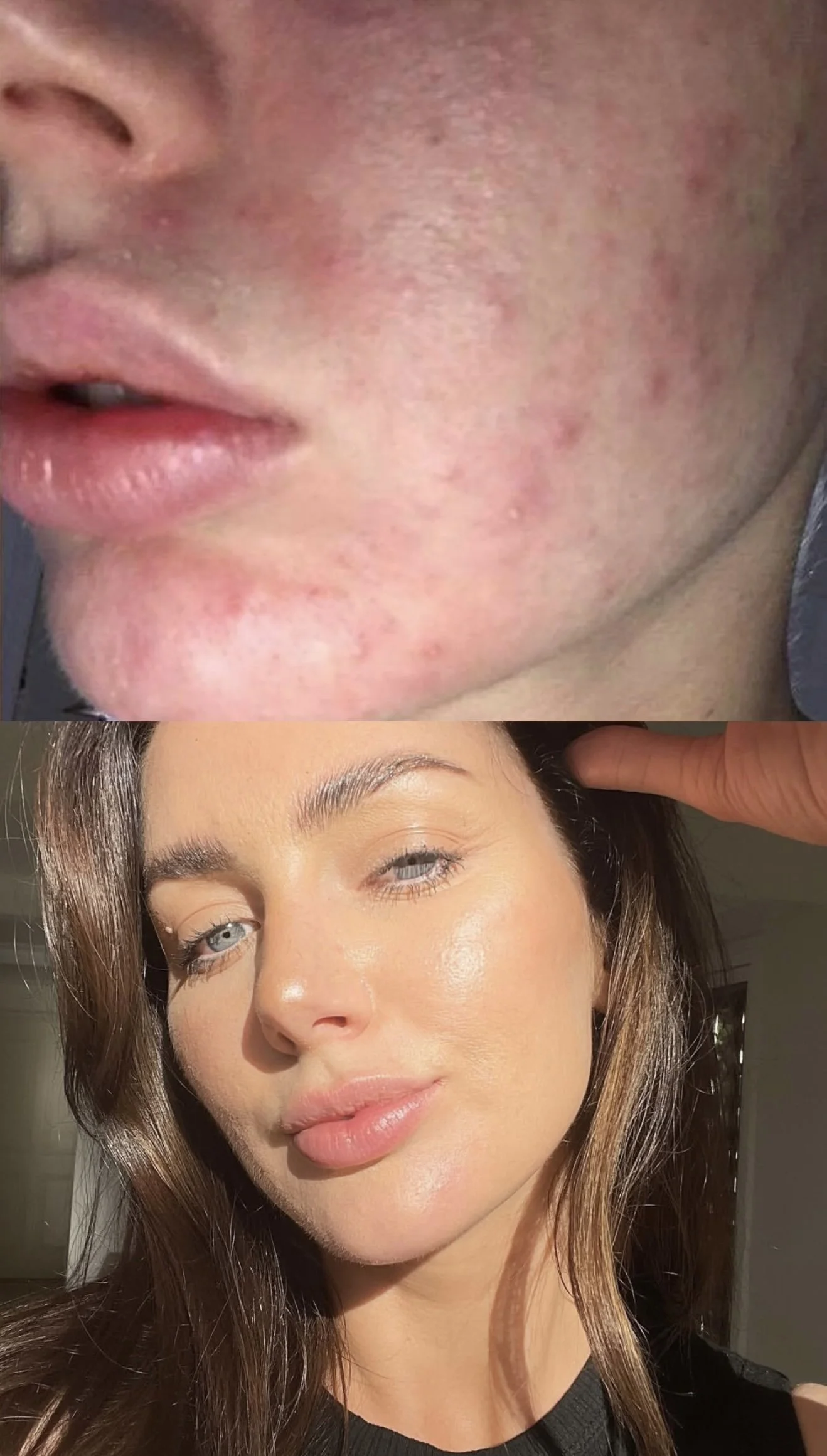 Acne After 25: Why Adult Skin Needs a Different Strategy