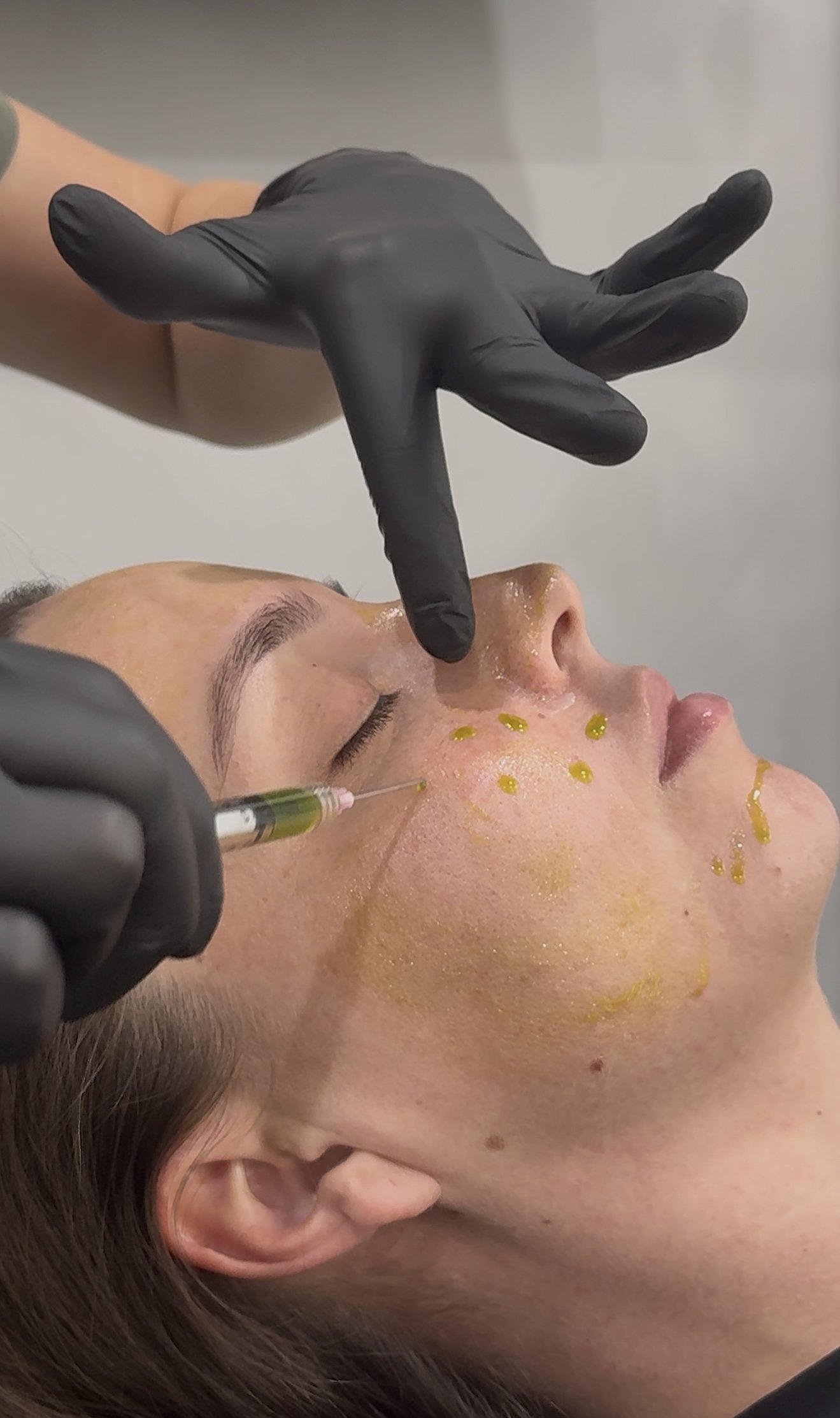 Why We Chose BioRePeel For Our Clinic
