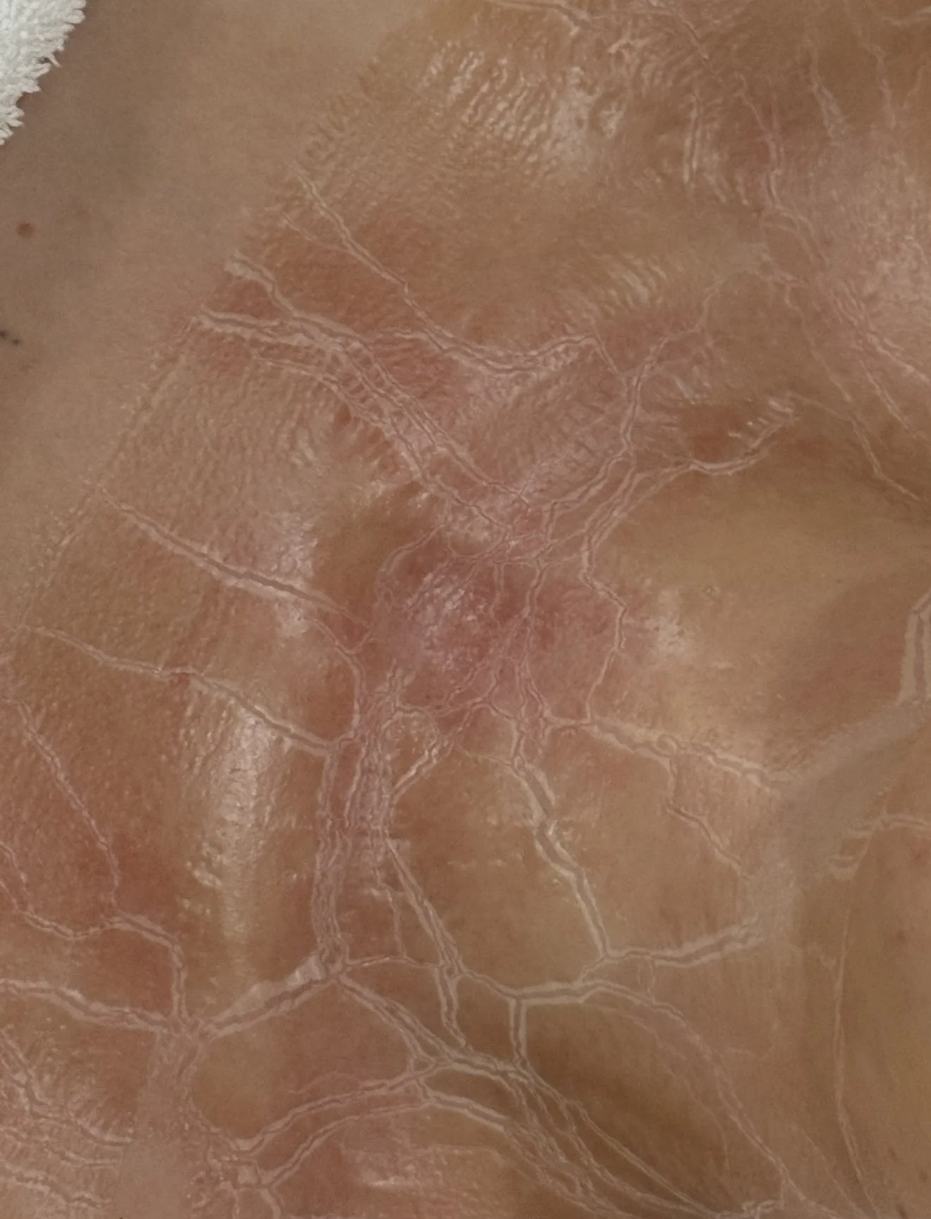 PRIN Lymphatic Therapy