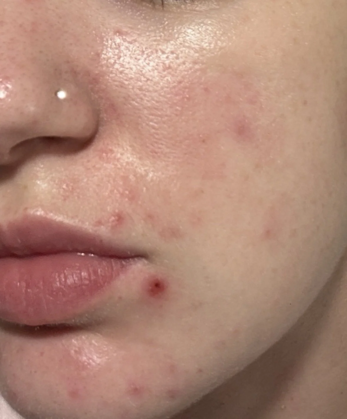 Skin Purge Or Skin Reaction