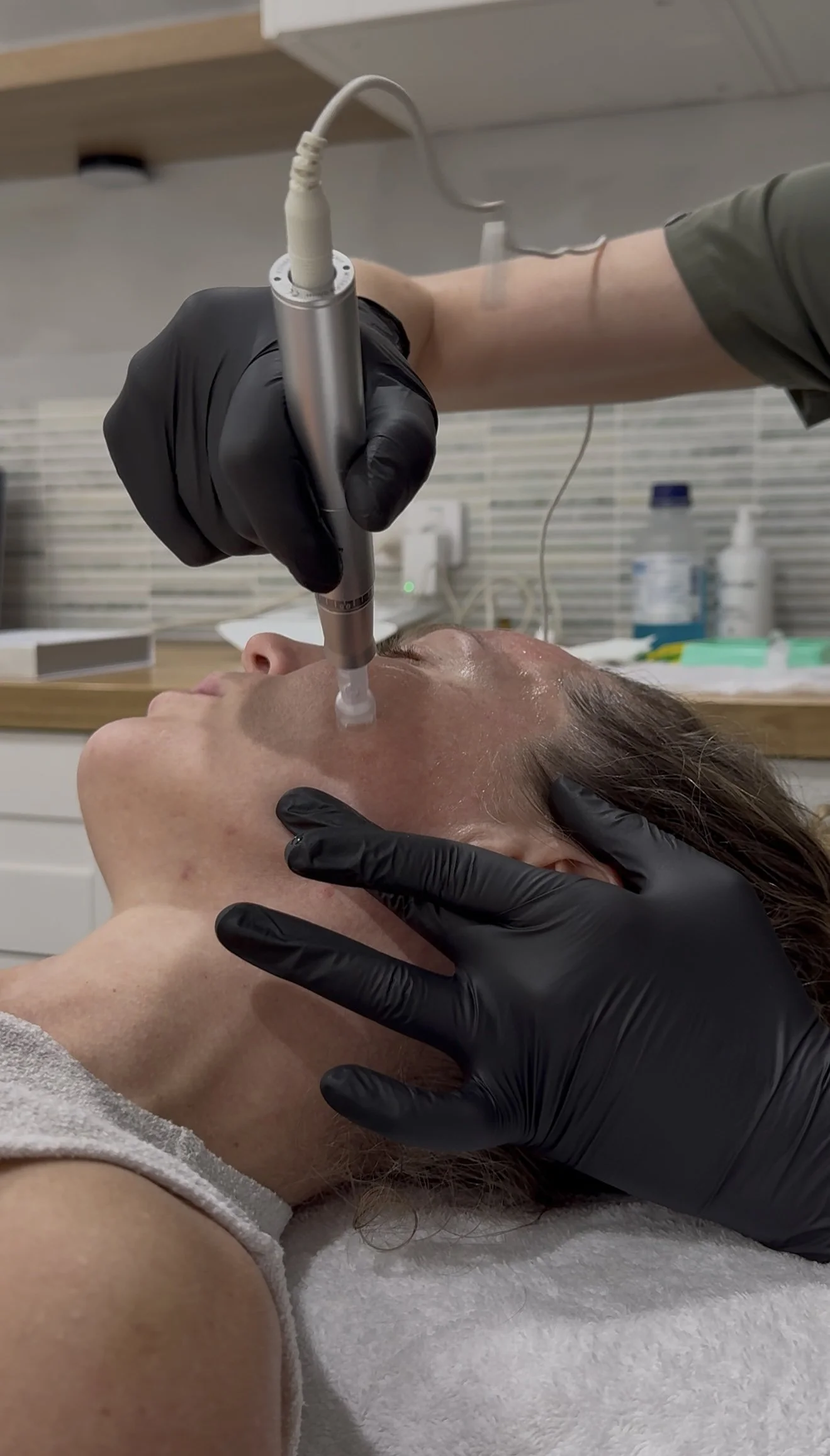 What Really Happens After Skin Needling? Week by Week
