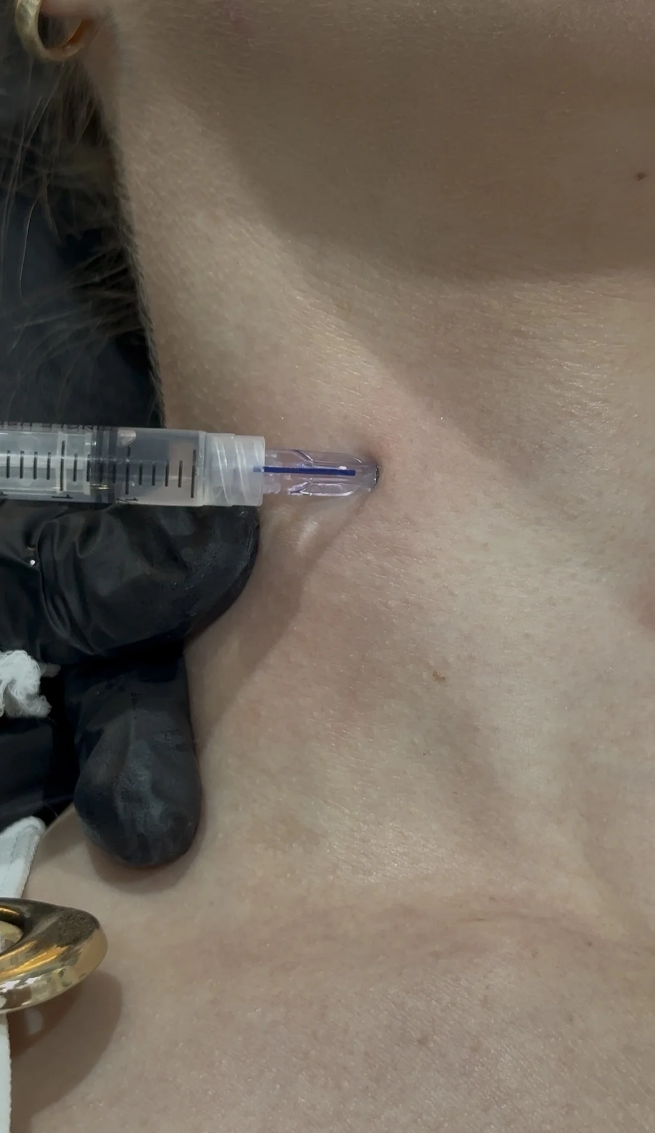 Is Your Jawline Losing Its Edge? How the Nefertiti Lift Targets the Muscles Pulling It Down