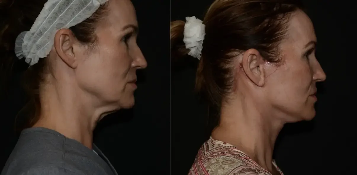Deep Plane Face and Neck Lift Before and After.webp