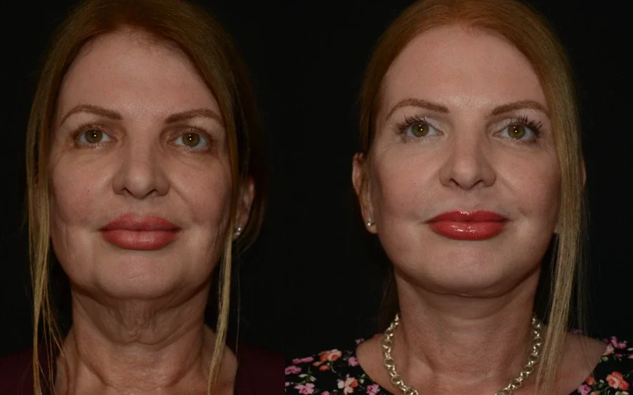 Facelift Transformation.webp