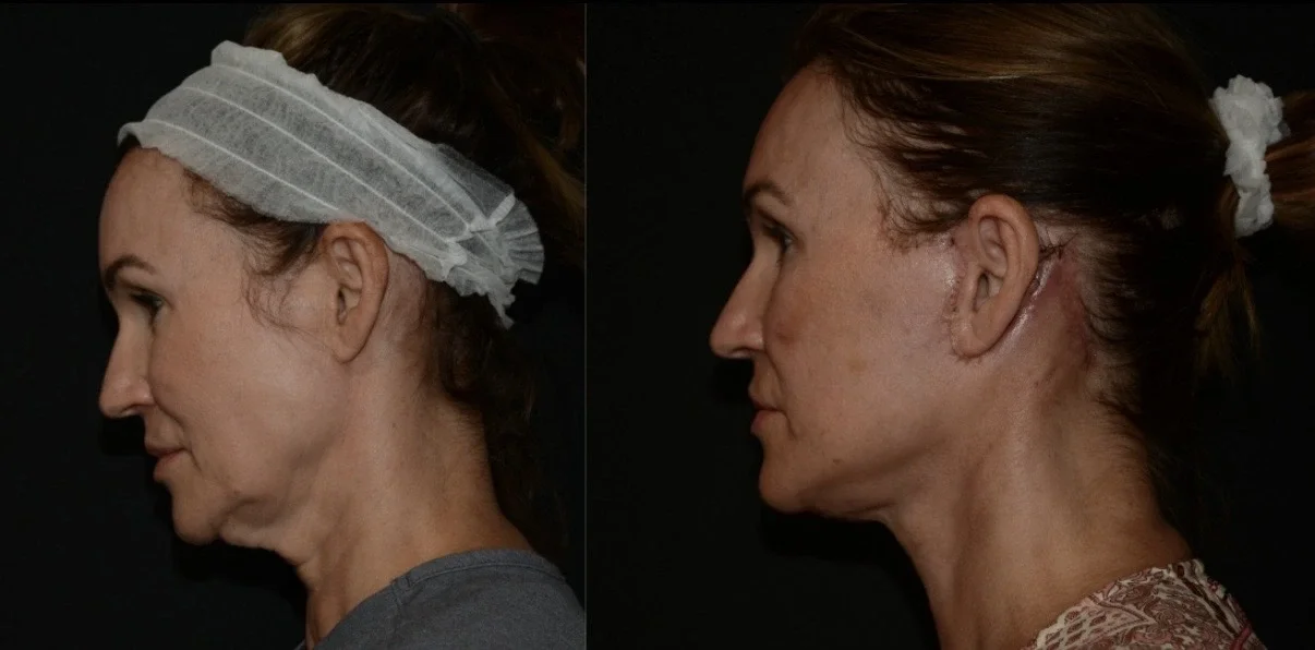Deep Plane Lift Facial Rejuvenation Results.webp