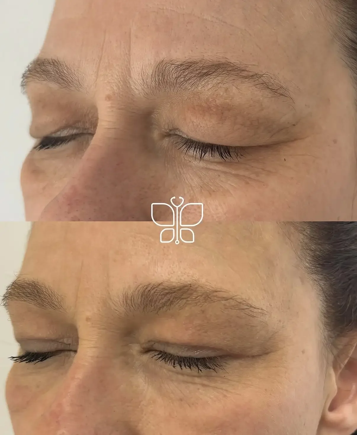 Before & After Upper Lid Blepharoplasty.webp