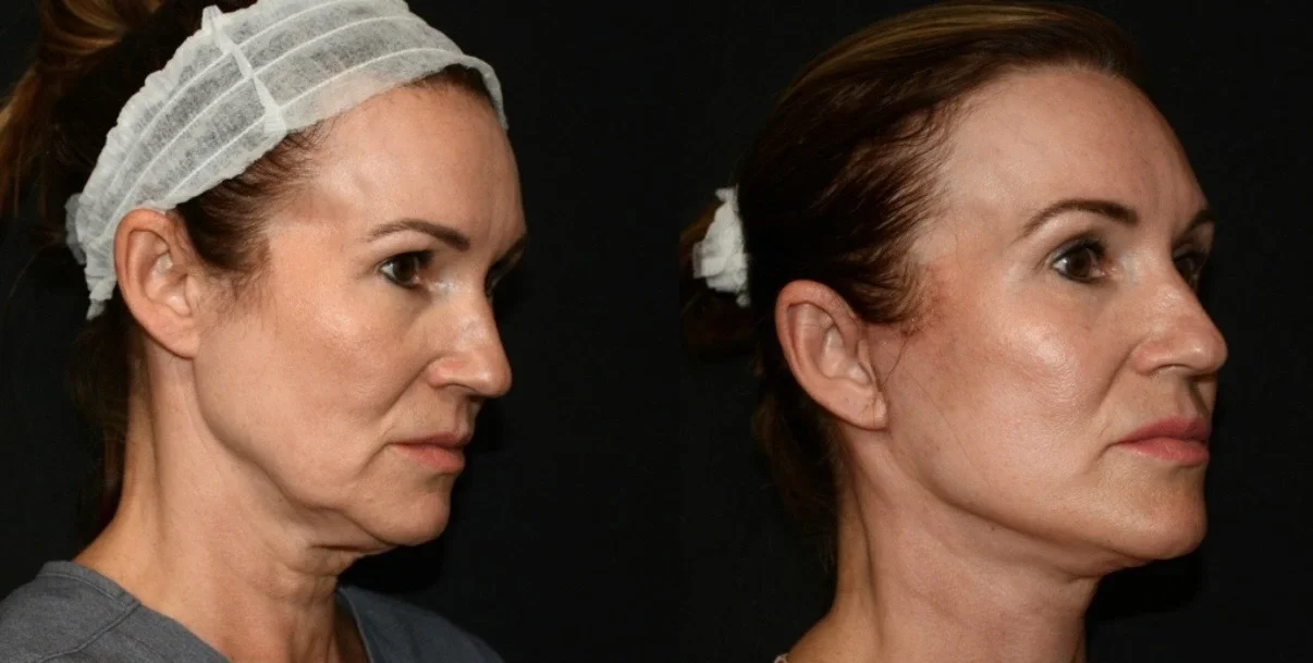 Deep Plane Lift Neck and Jawline Results.webp
