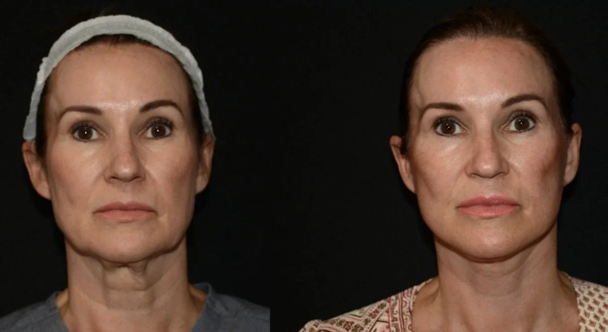 Deep Plane Face and Neck Lift Outcome.webp