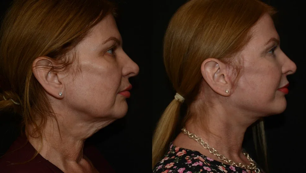 Facelift Treatment Results.webp