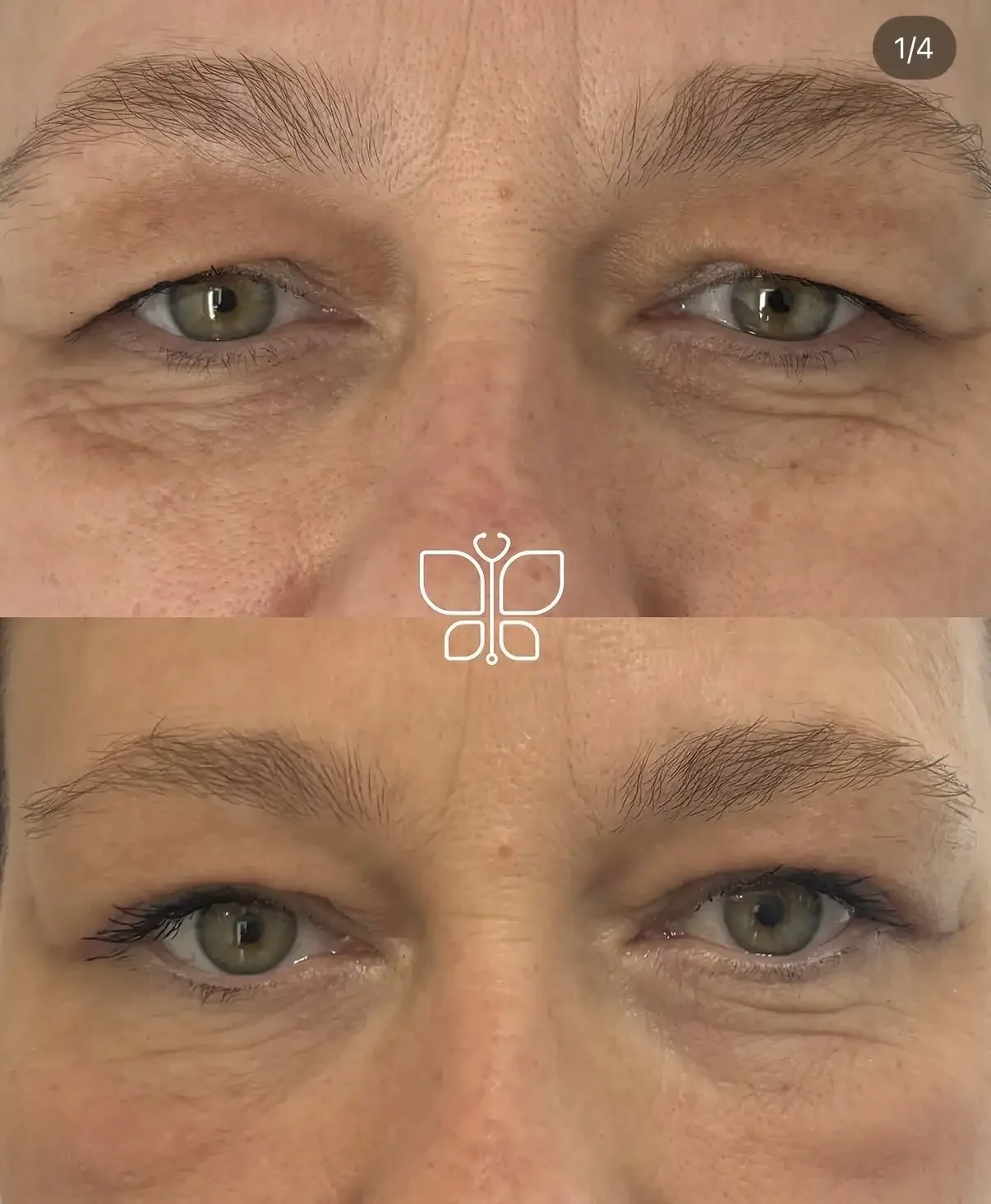 Upper Blepharoplasty Patient Results.webp
