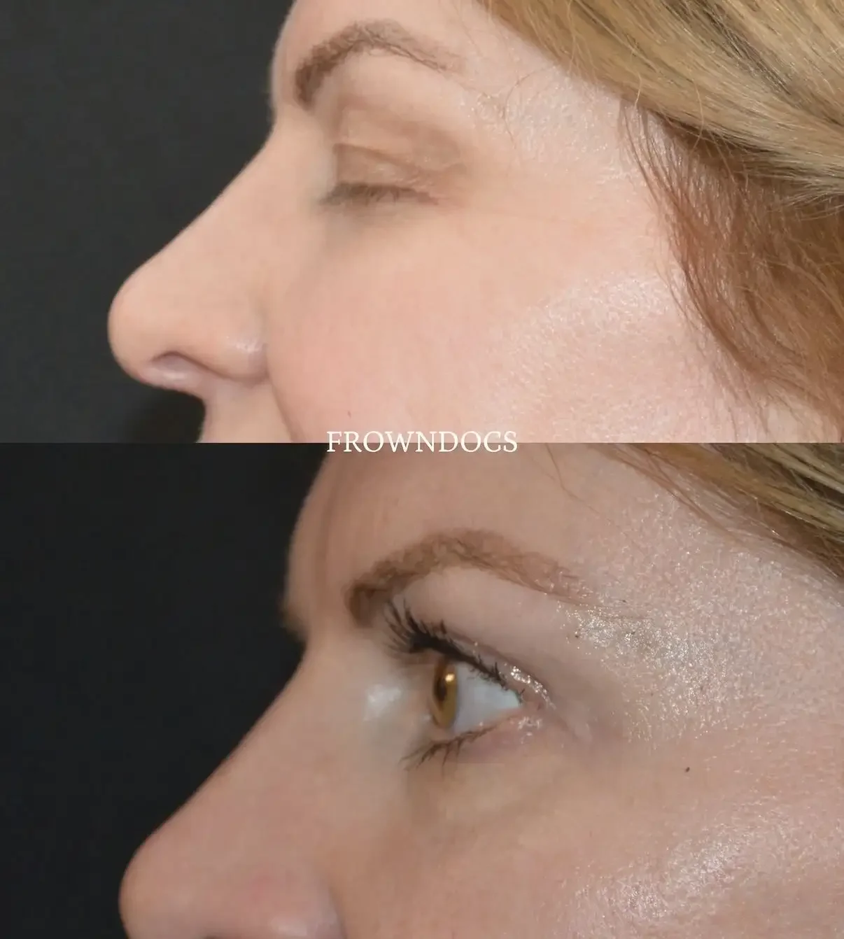 Before & After Upper Blepharoplasty.webp