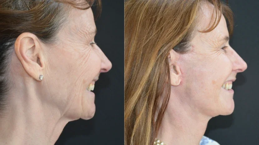 Facelift Before & After.webp