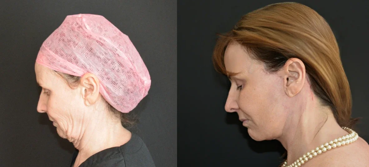 Facelift Surgery Before & After.webp