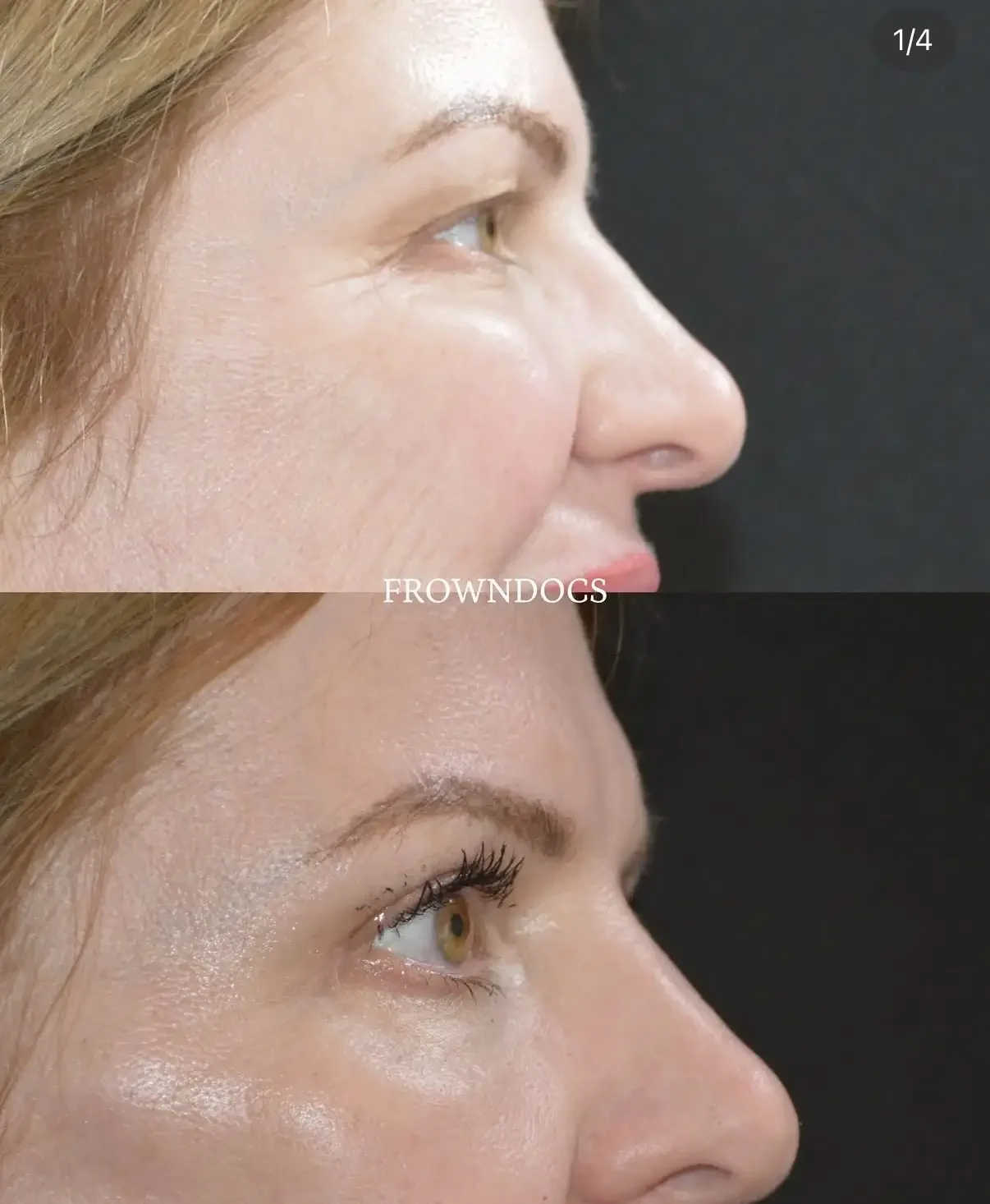 Upper Blepharoplasty Before & After.webp