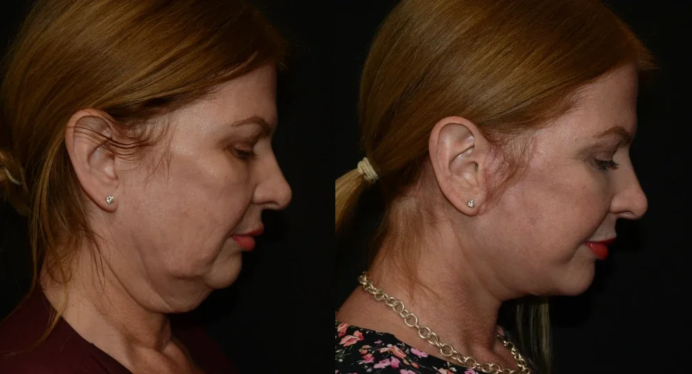 Facelift Surgery Transformation.webp