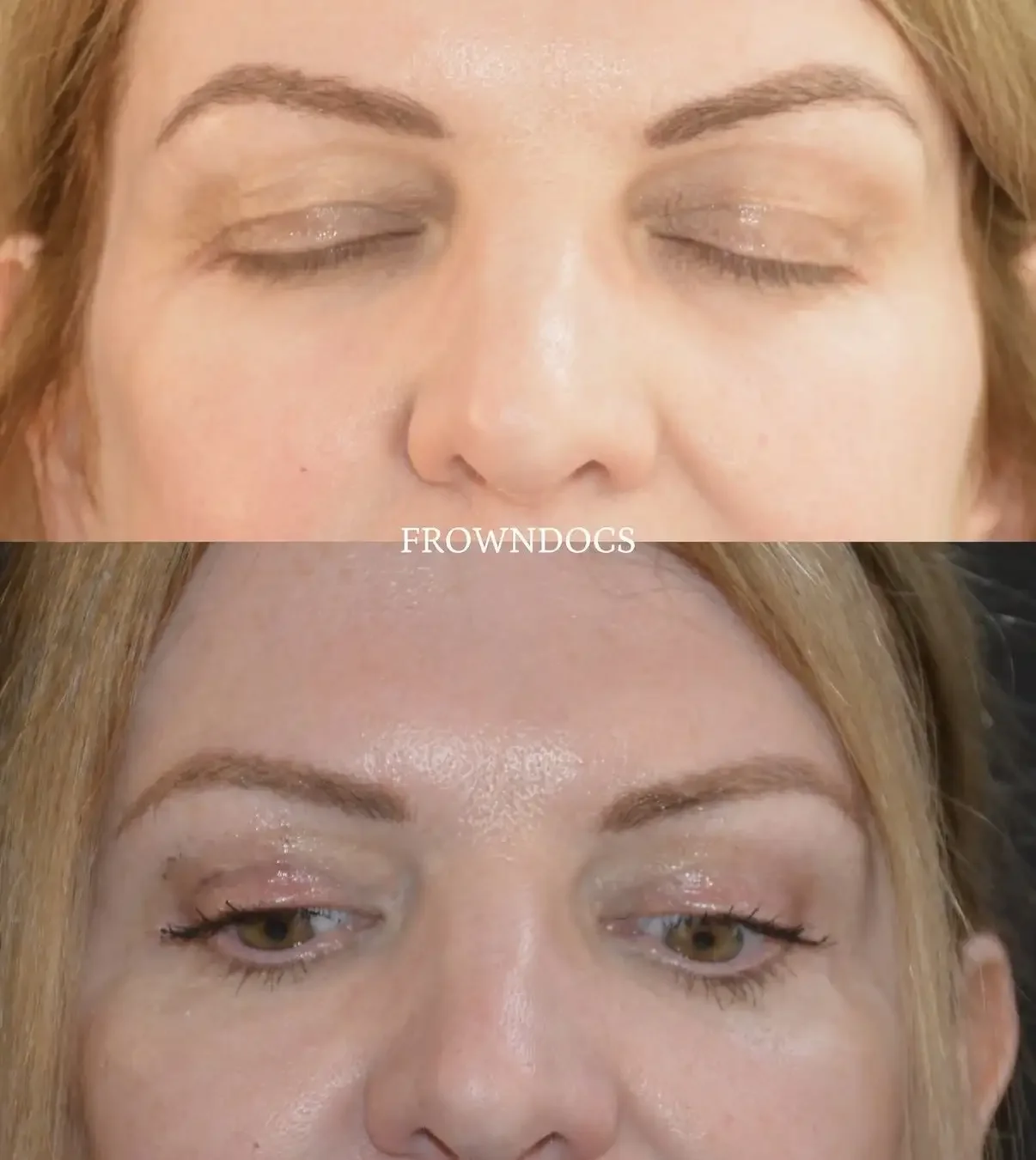 Upper Blepharoplasty Transformation.webp