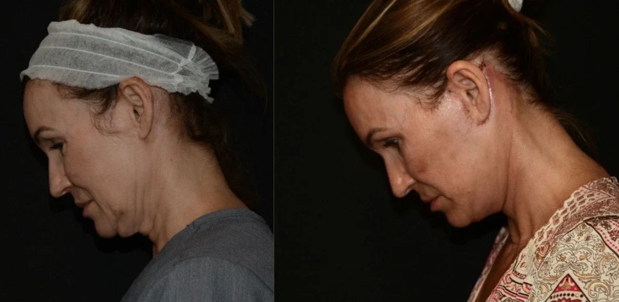 Before and After Deep Plane Lift.webp