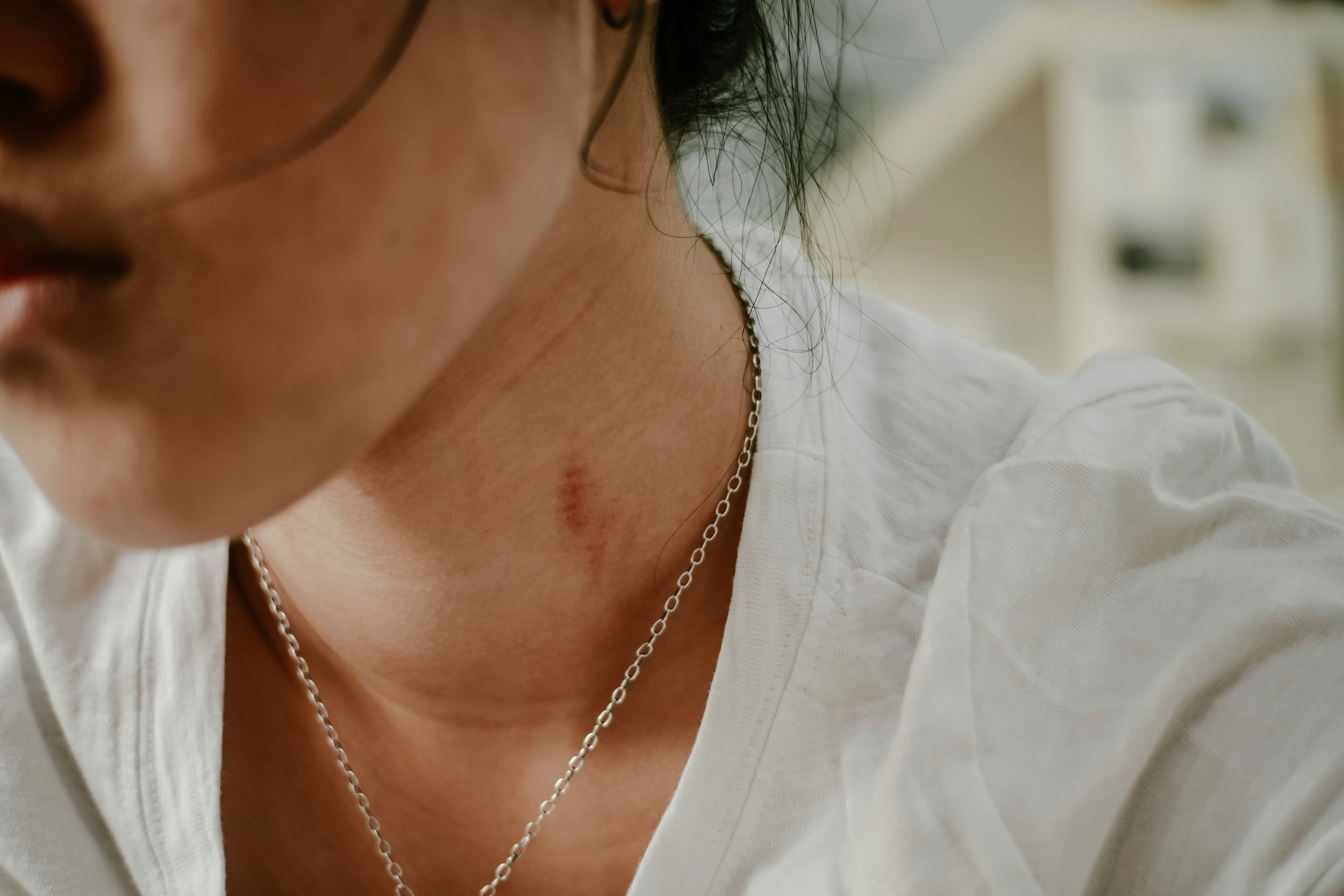 Scar Revision